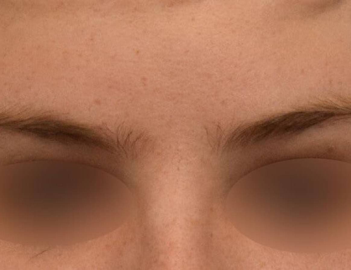 Brow Bossing Reduction Before & After Image