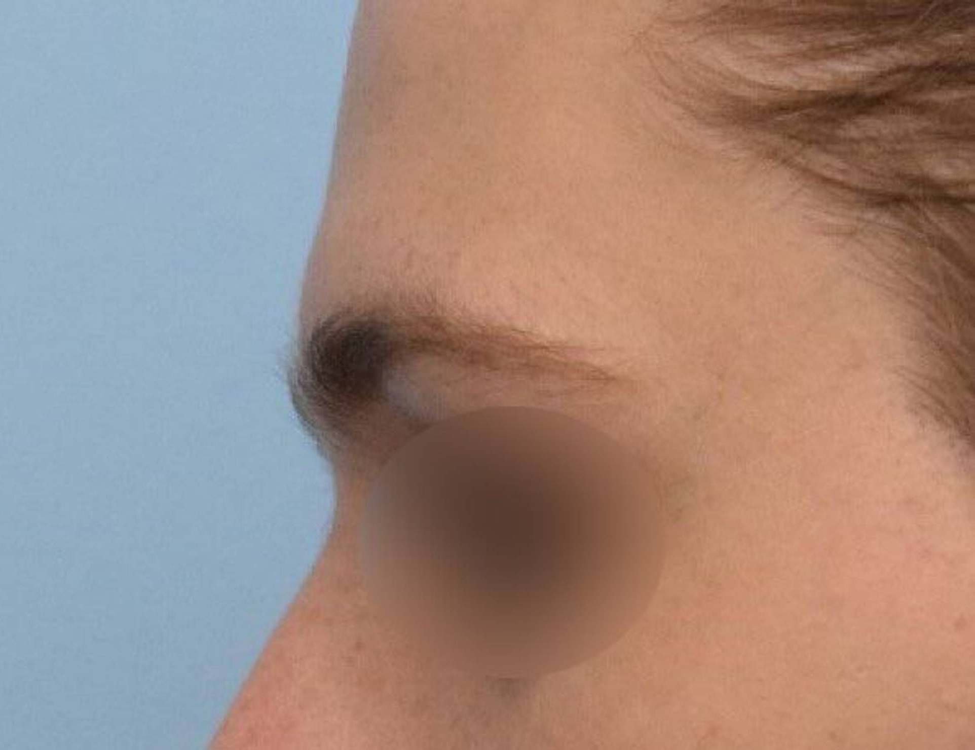 Brow Bossing Reduction Before & After Image