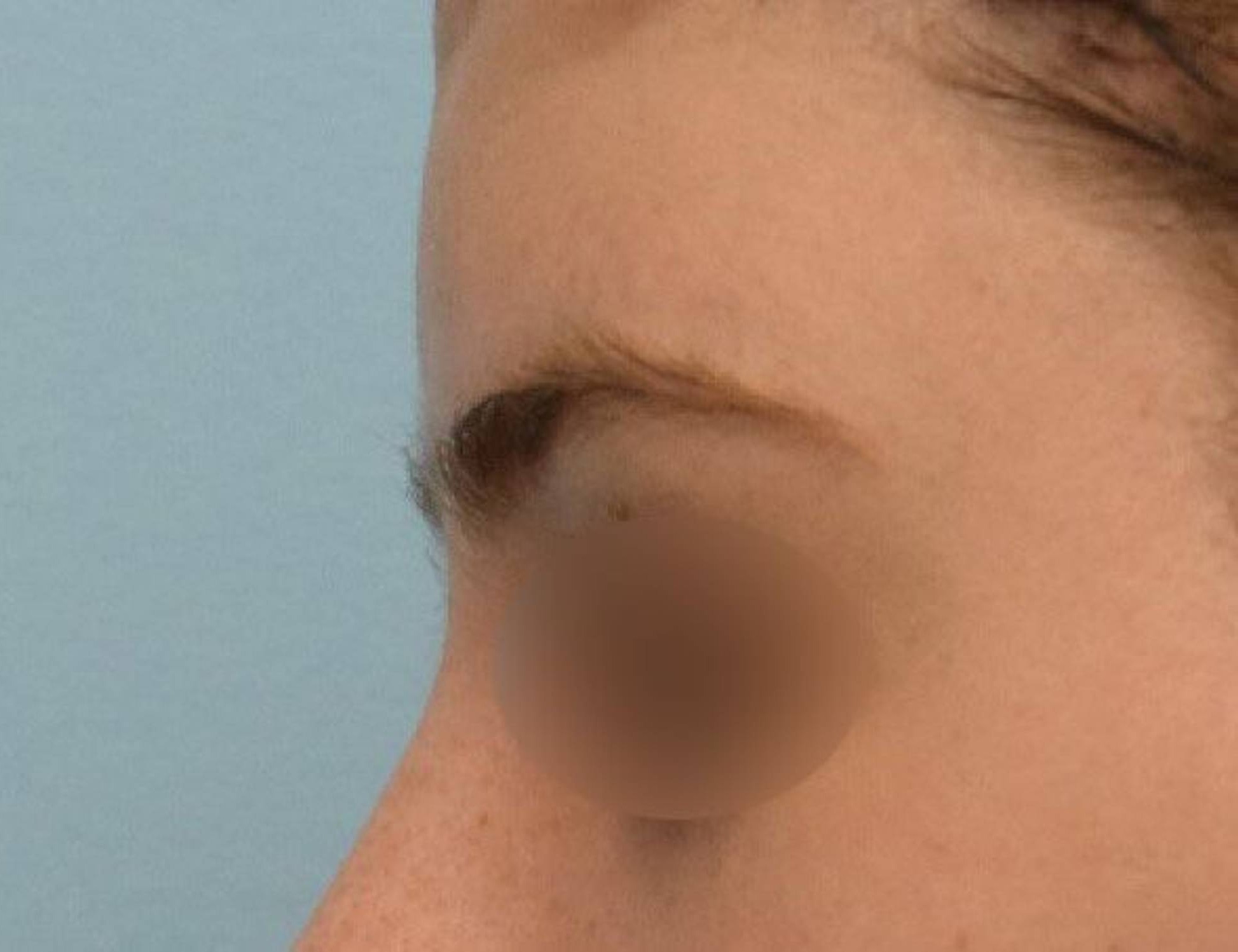 Brow Bossing Reduction Before & After Image