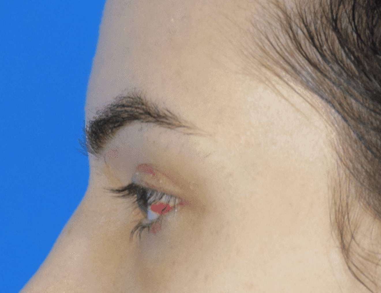 Brow Bossing Reduction Before & After Image