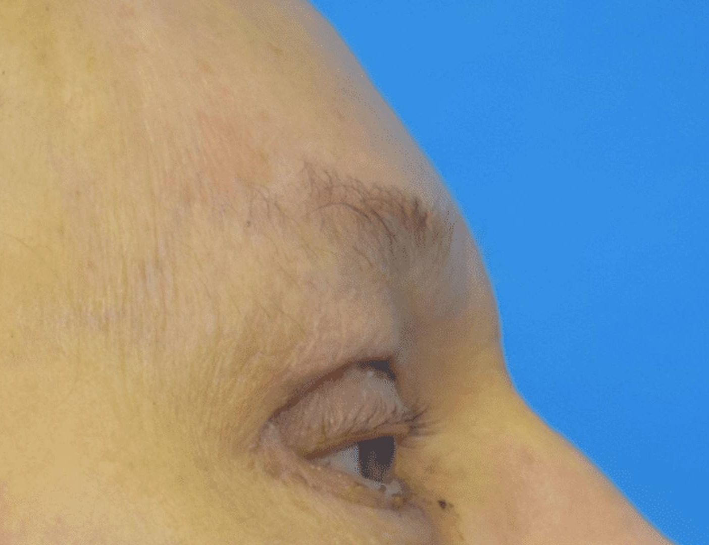 Brow Bossing Reduction Before & After Image