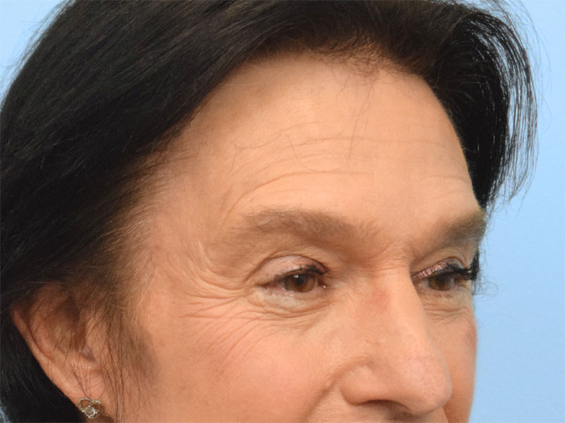 Brow Bossing Reduction Before & After Image
