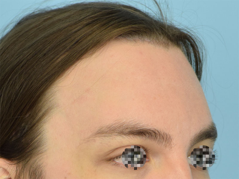 Brow Bossing Reduction Before & After Image