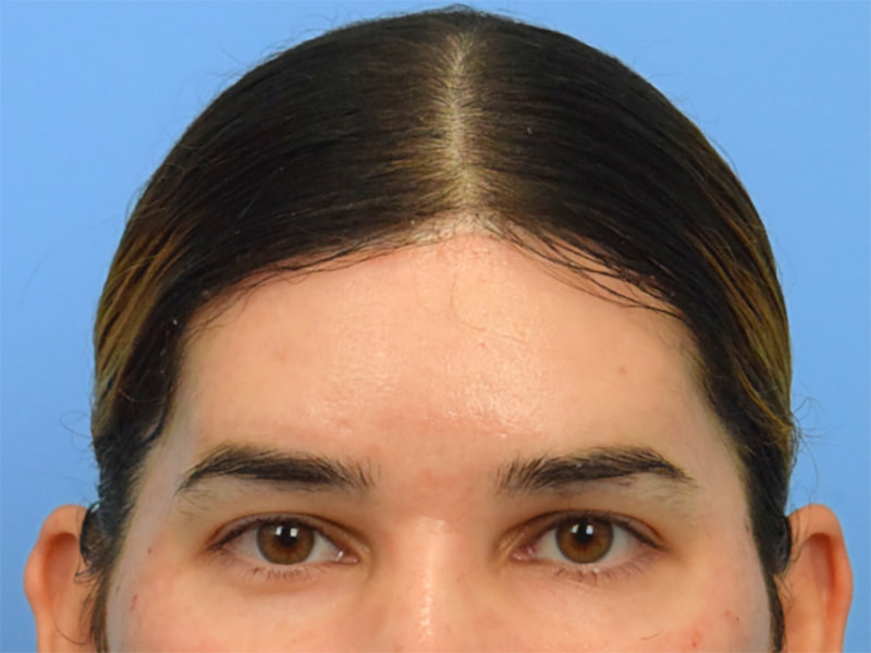 Brow Bossing Reduction Before & After Image