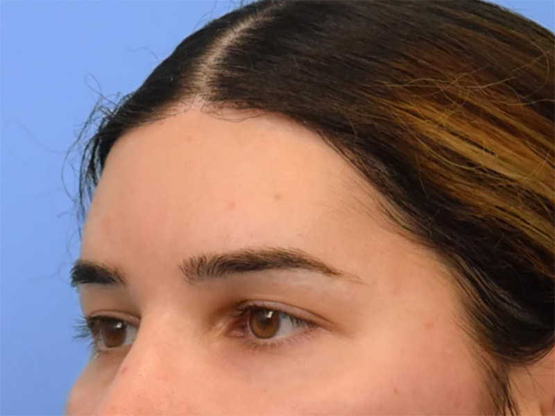 Brow Bossing Reduction Before & After Image