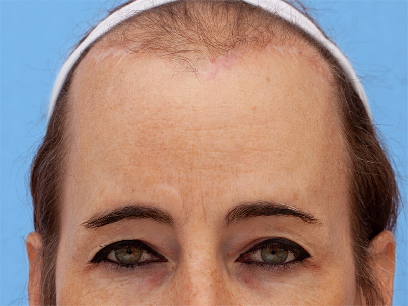 Brow Bossing Reduction Before & After Image