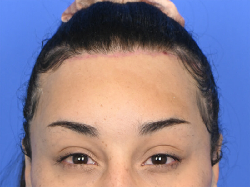 Brow Bossing Reduction Before & After Image