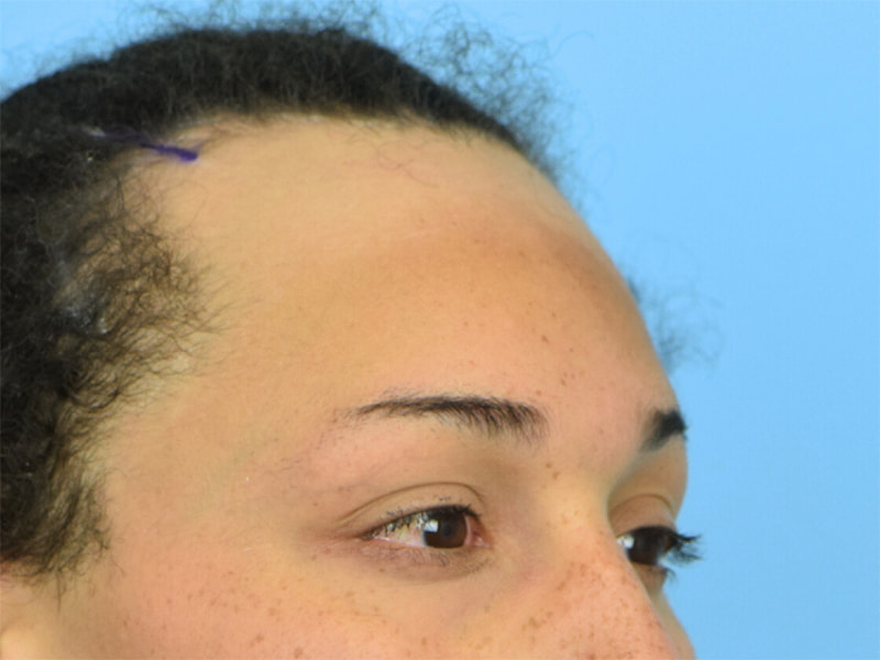 Brow Bossing Reduction Before & After Image