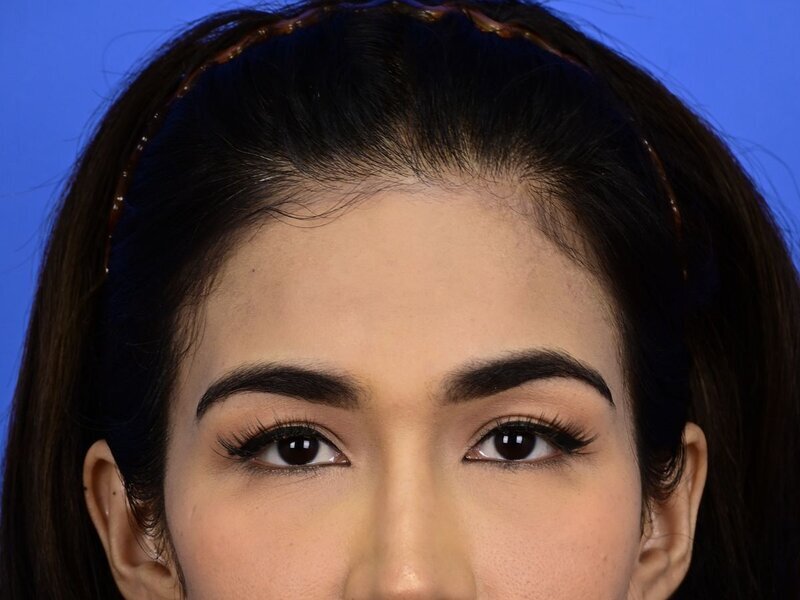 Brow Bossing Reduction Before & After Image