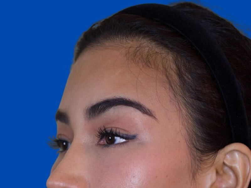 Brow Bossing Reduction Before & After Image