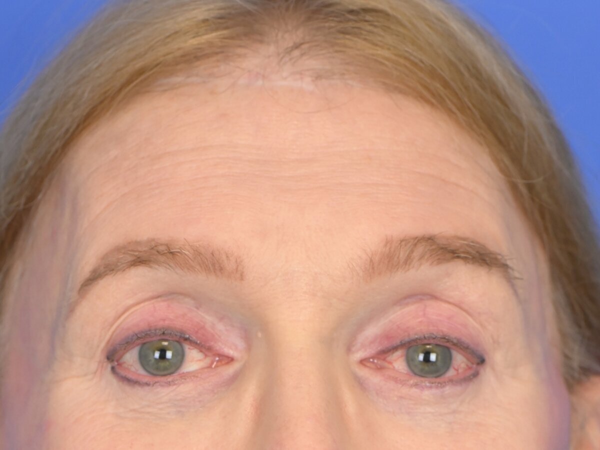 Brow Bossing Reduction Before & After Image