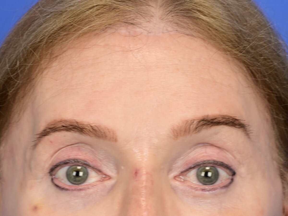 Brow Bossing Reduction Before & After Image