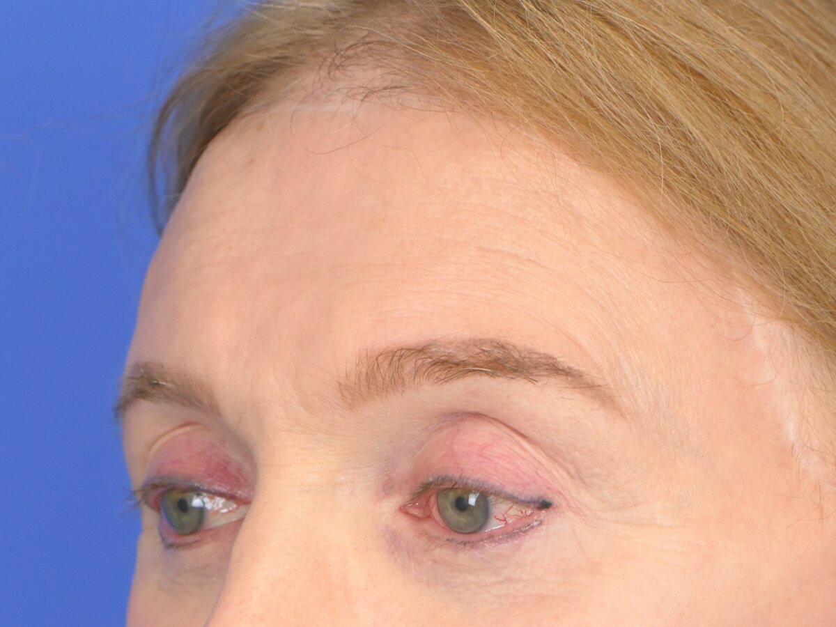 Brow Bossing Reduction Before & After Image