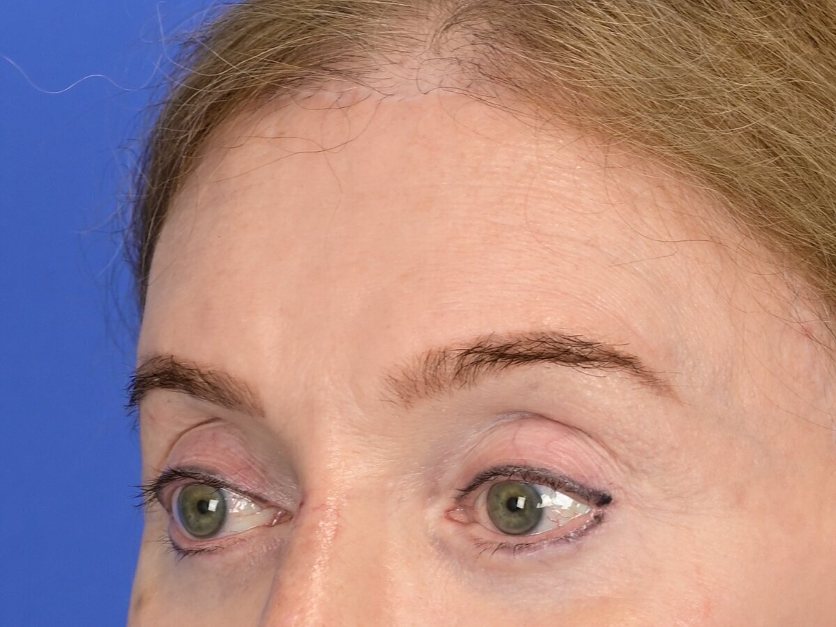 Brow Bossing Reduction Before & After Image