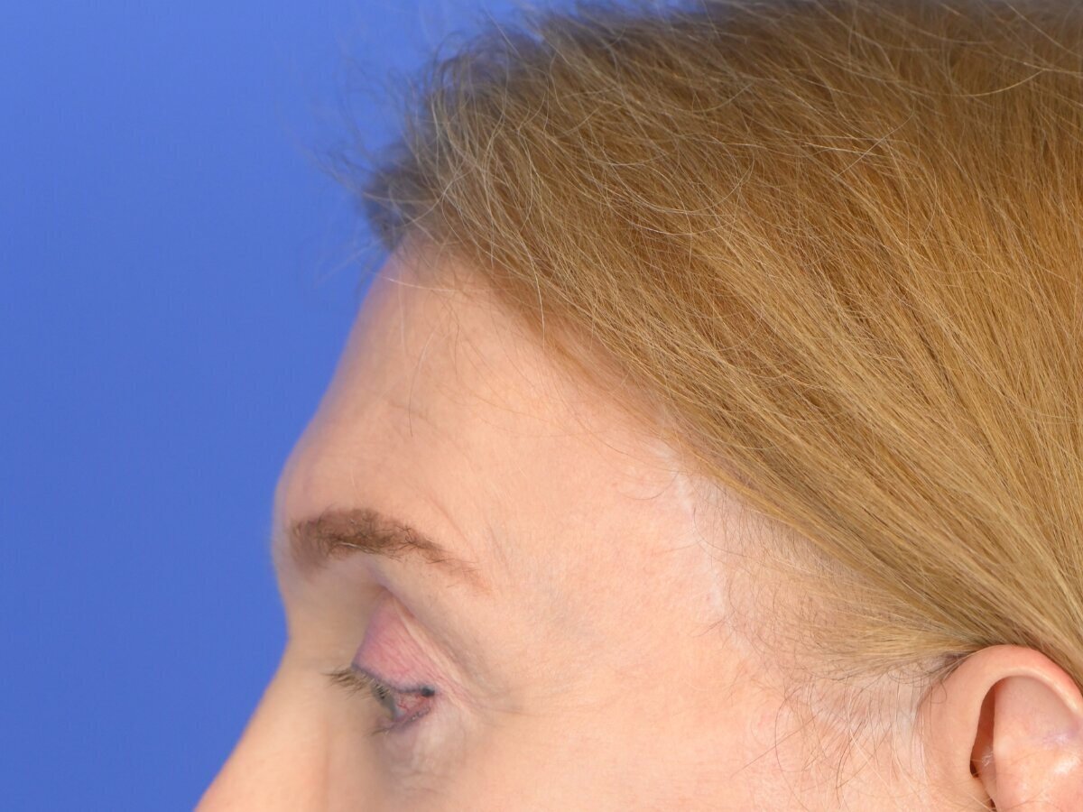 Brow Bossing Reduction Before & After Image