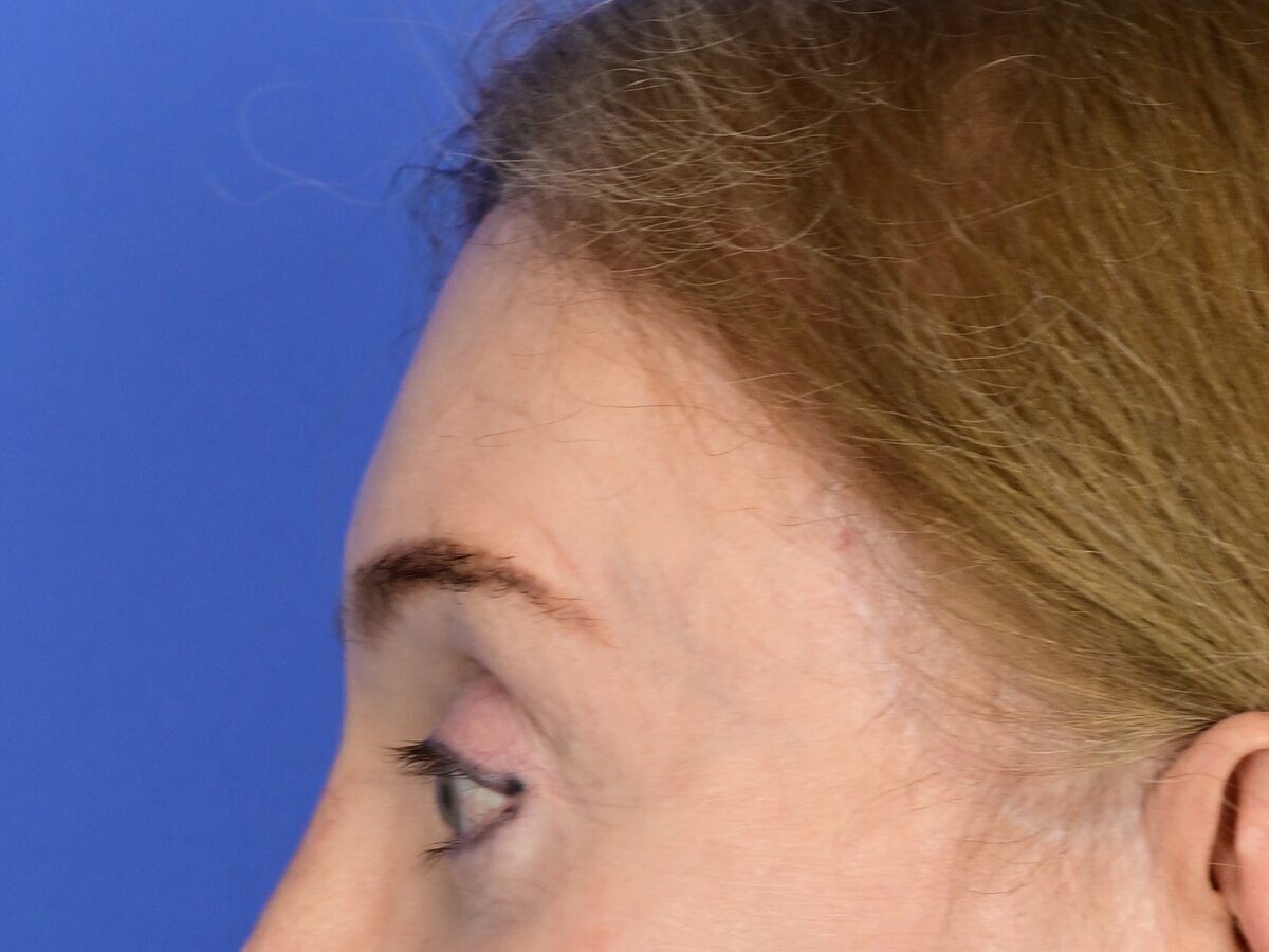 Brow Bossing Reduction Before & After Image