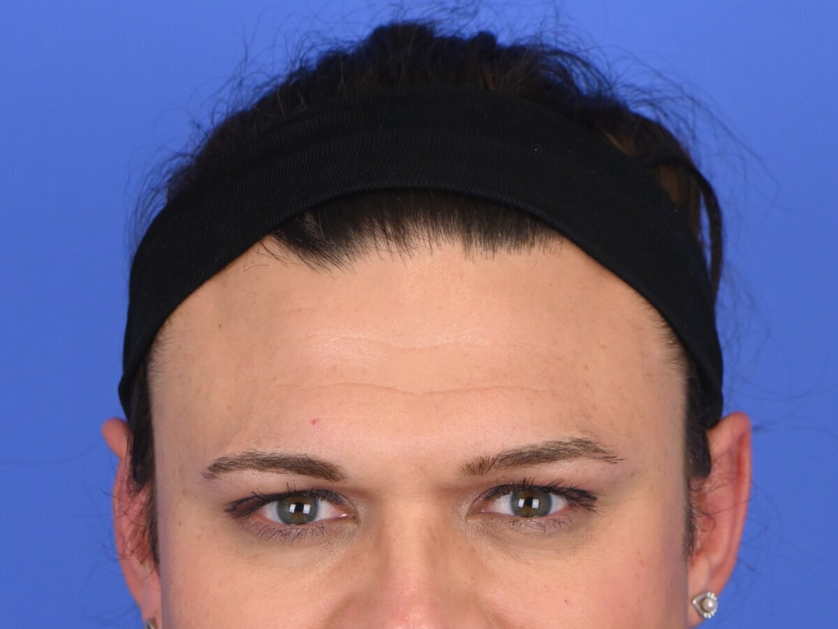 Brow Bossing Reduction Before & After Image