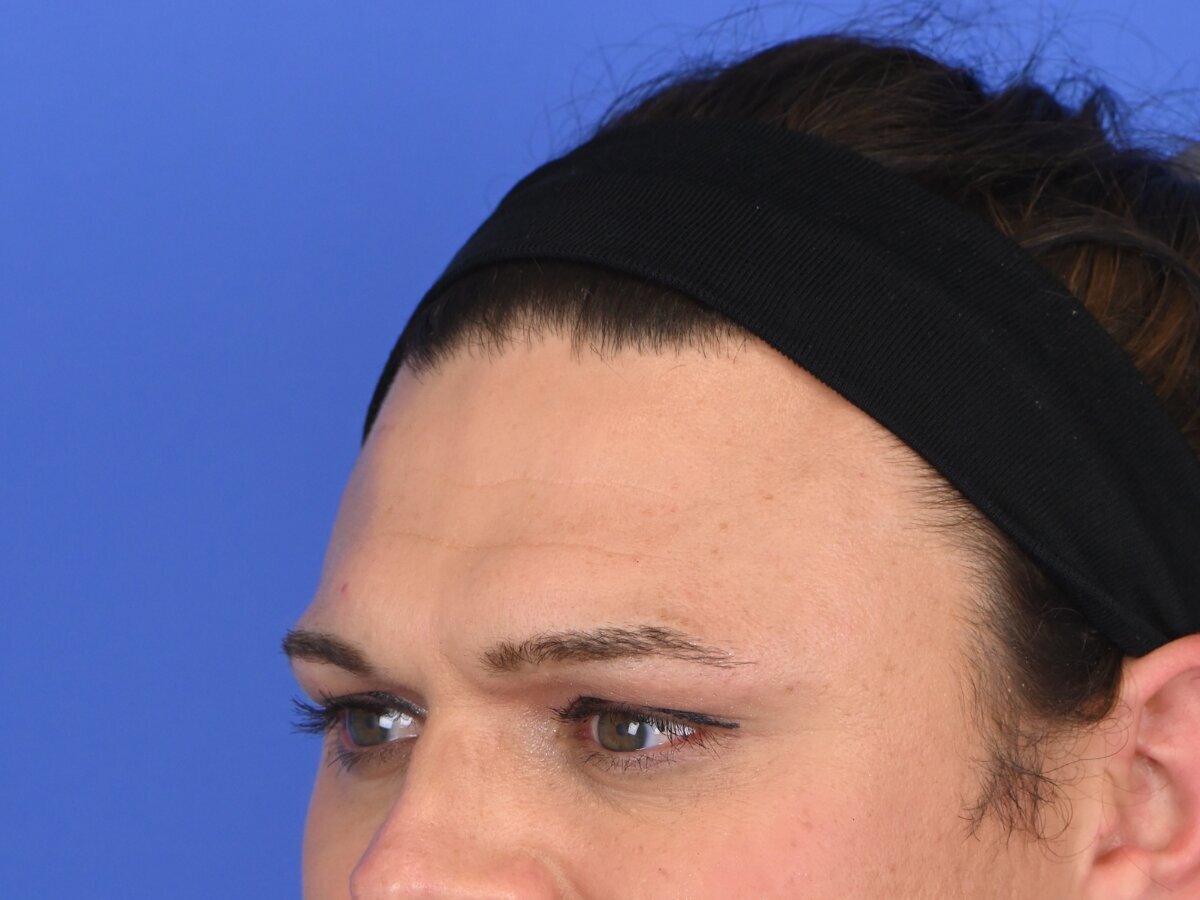 Brow Bossing Reduction Before & After Image