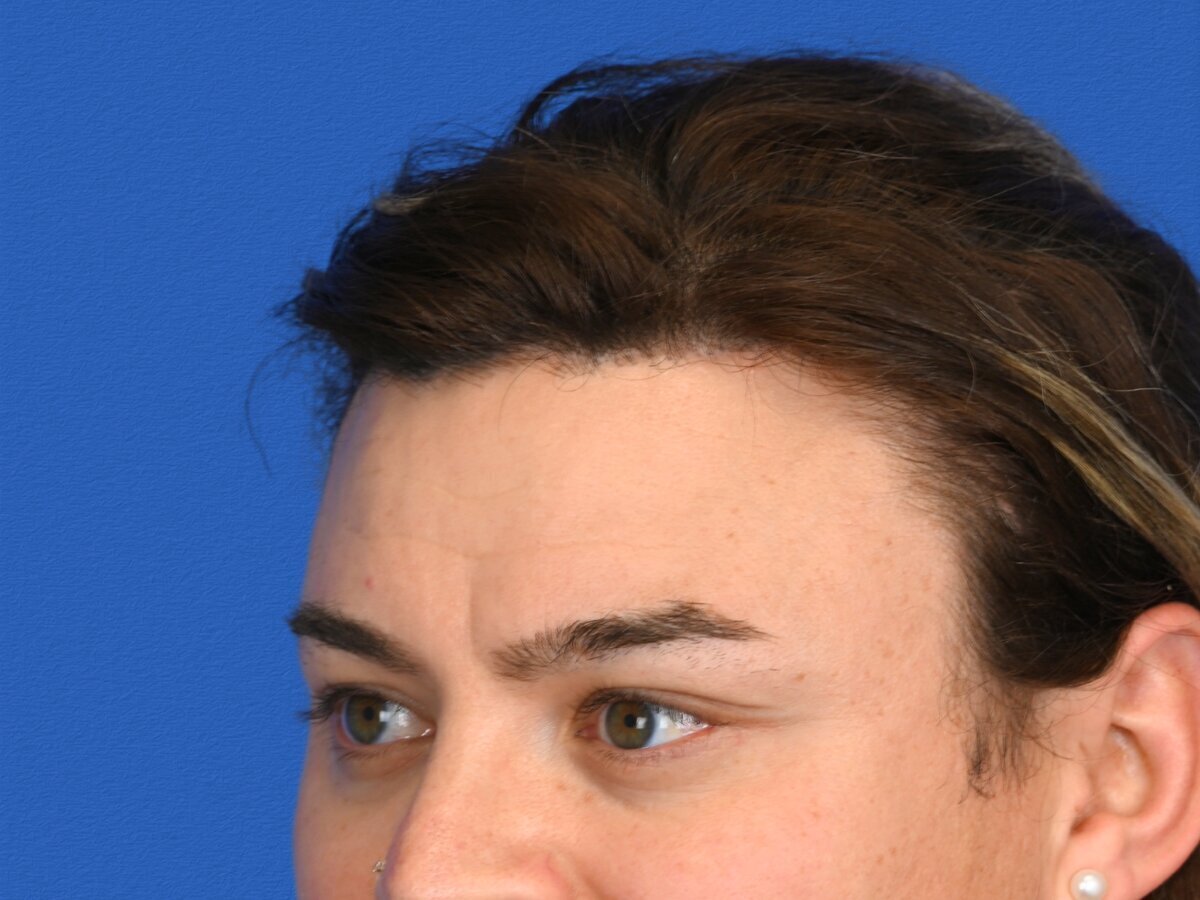 Brow Bossing Reduction Before & After Image