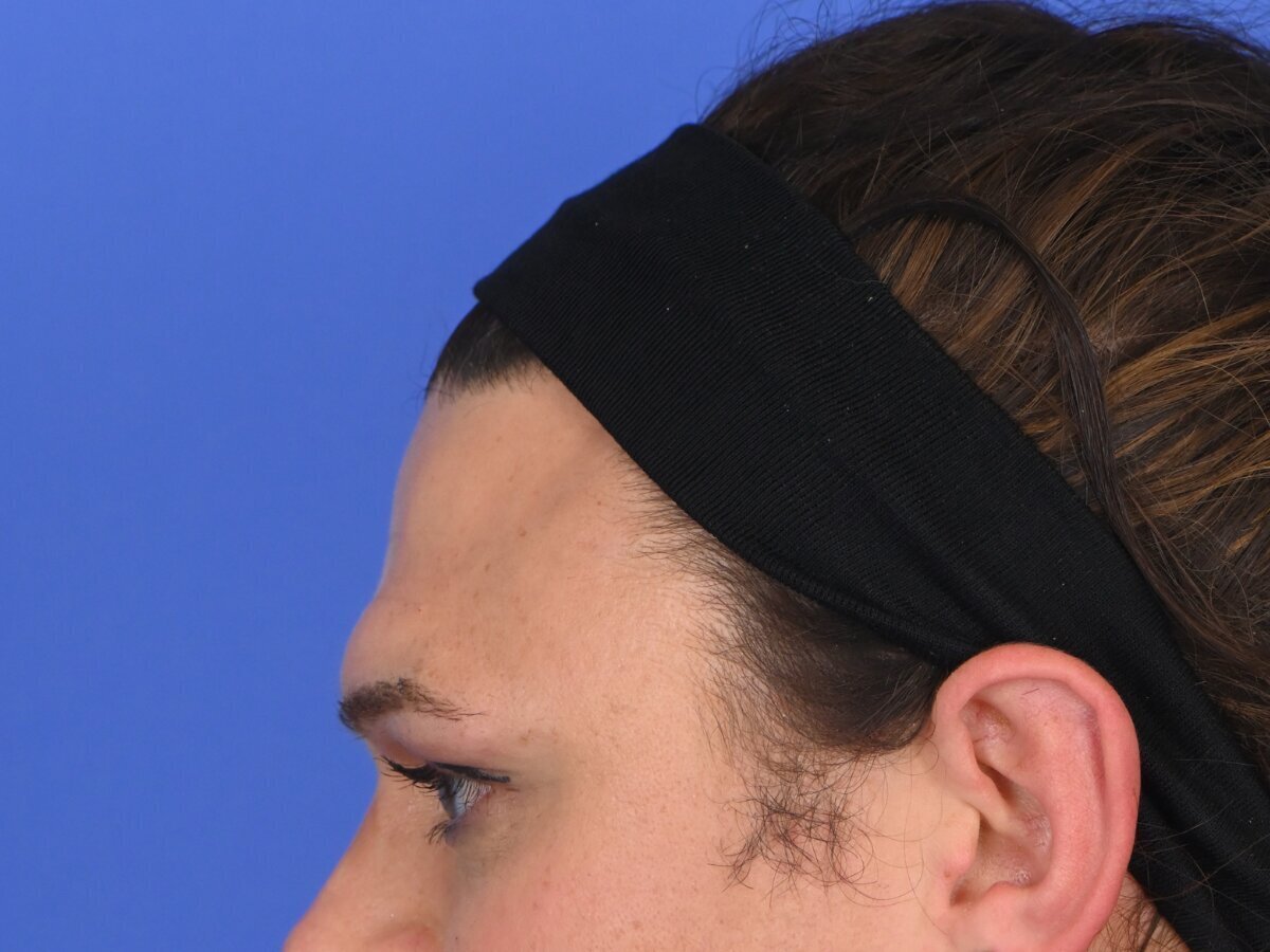 Brow Bossing Reduction Before & After Image