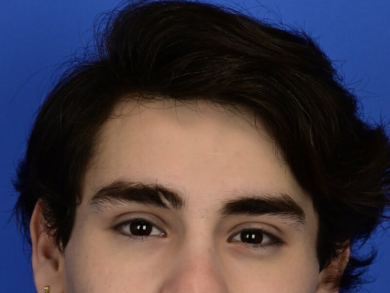 Brow Bossing Reduction Before & After Image