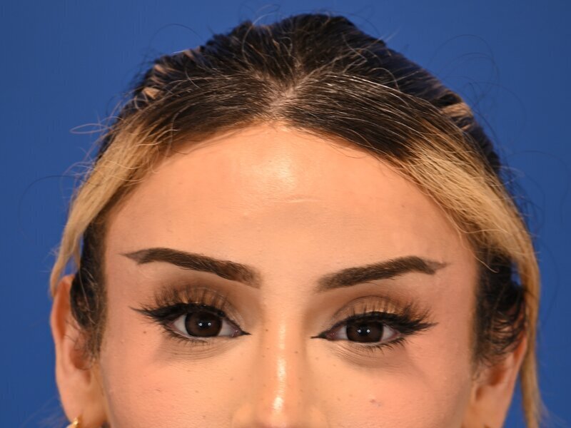 Brow Bossing Reduction Before & After Image