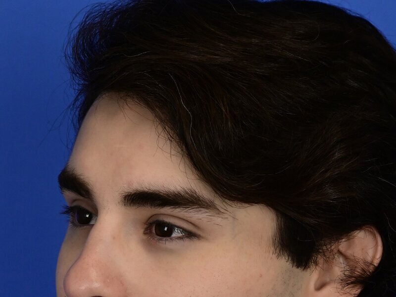 Brow Bossing Reduction Before & After Image