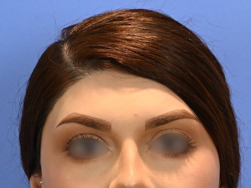 Brow Bossing Reduction Before & After Image
