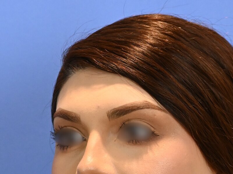 Brow Bossing Reduction Before & After Image