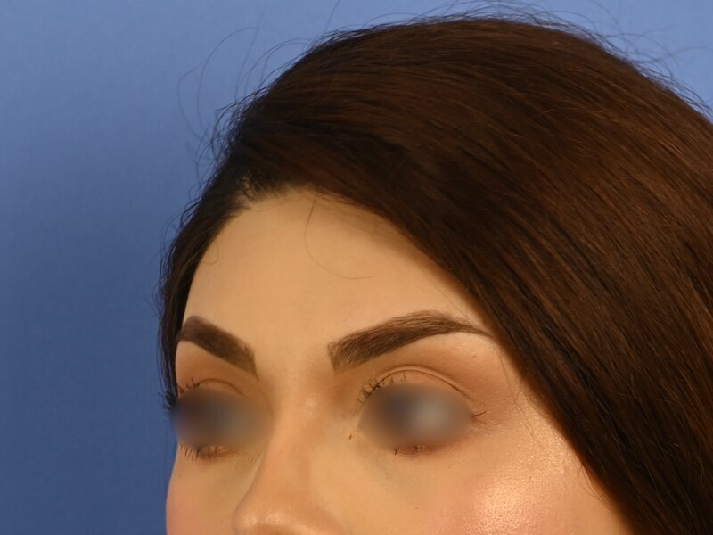 Brow Bossing Reduction Before & After Image
