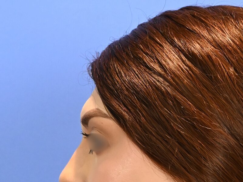 Brow Bossing Reduction Before & After Image