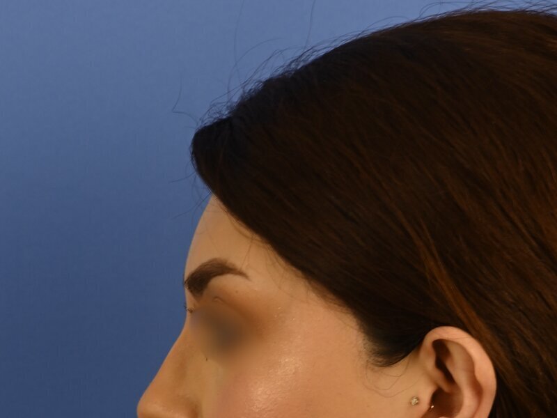 Brow Bossing Reduction Before & After Image