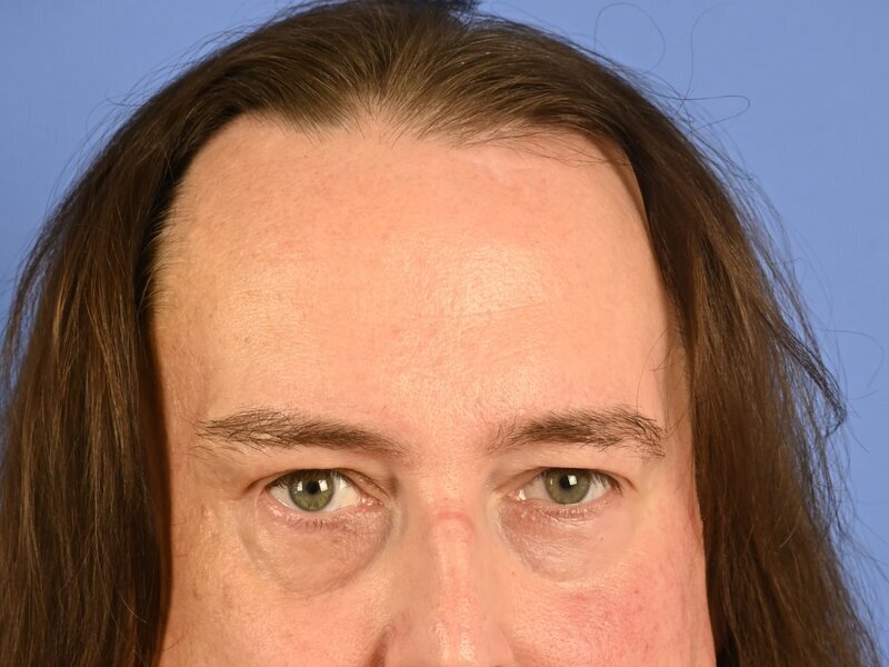 Brow Bossing Reduction Before & After Image