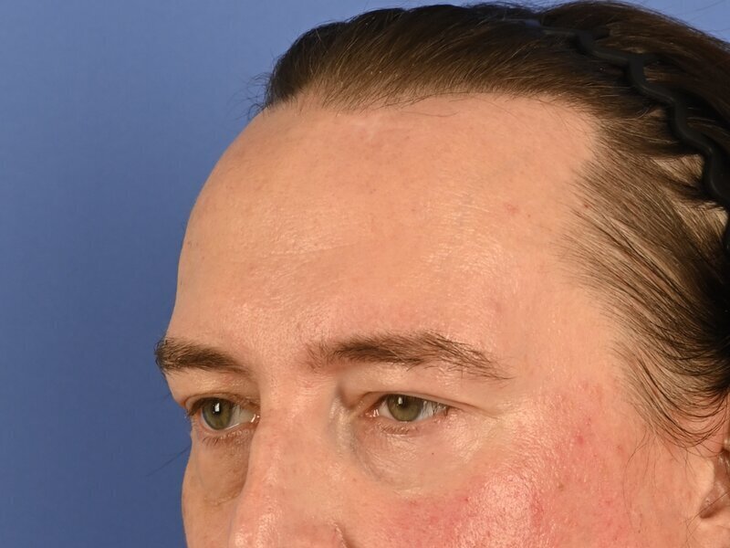Brow Bossing Reduction Before & After Image