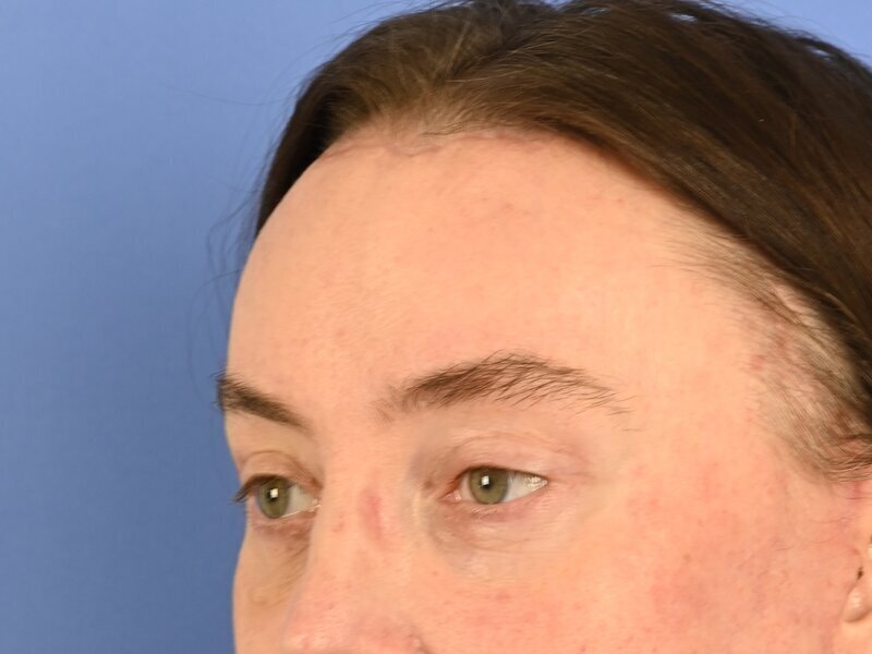 Brow Bossing Reduction Before & After Image