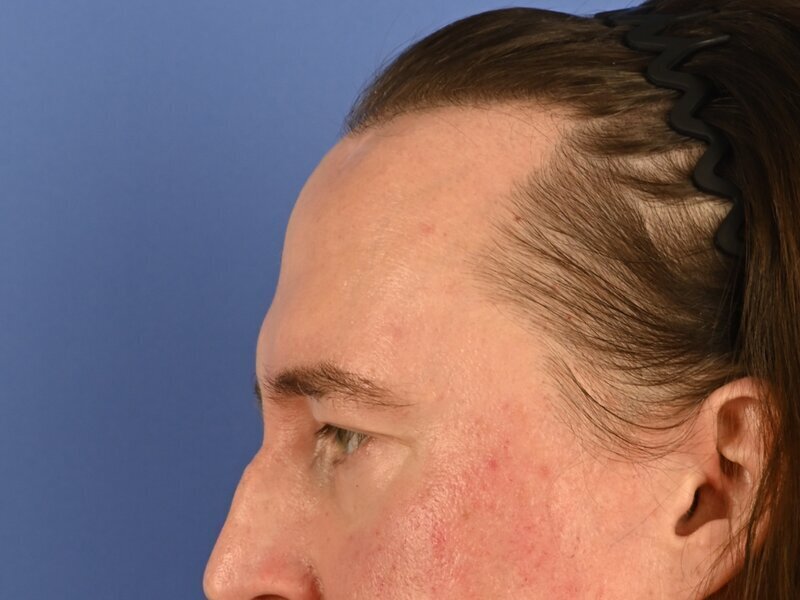 Brow Bossing Reduction Before & After Image