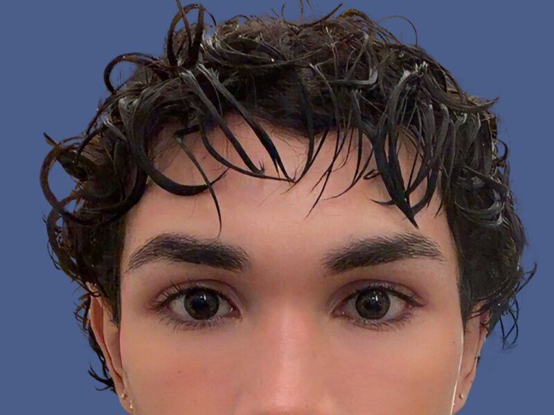Brow Bossing Reduction Before & After Image