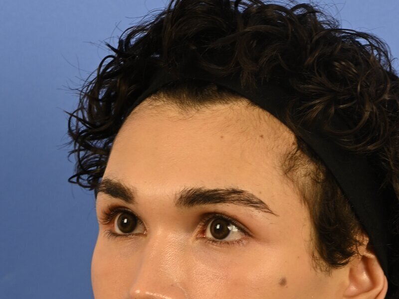 Brow Bossing Reduction Before & After Image