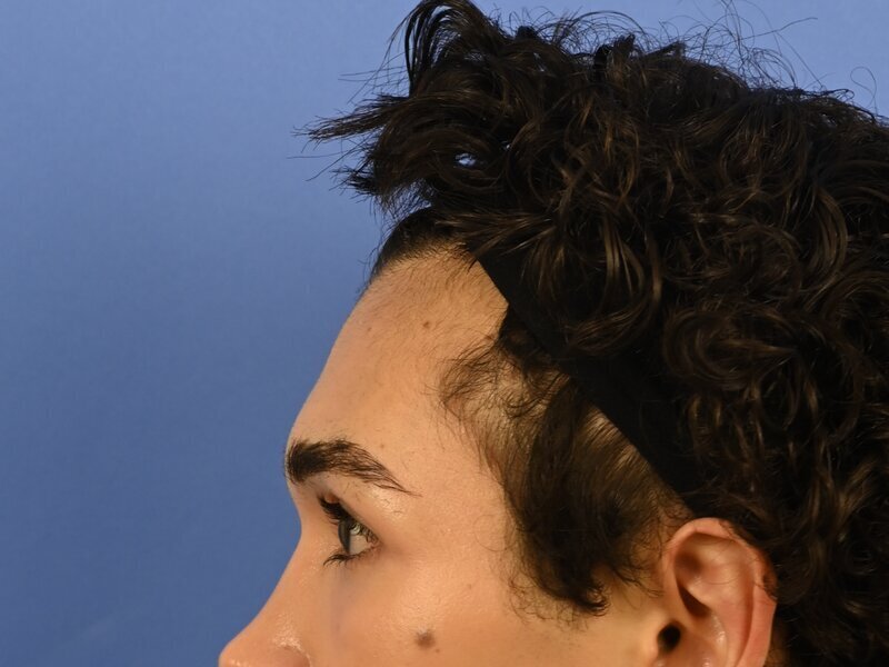 Brow Bossing Reduction Before & After Image