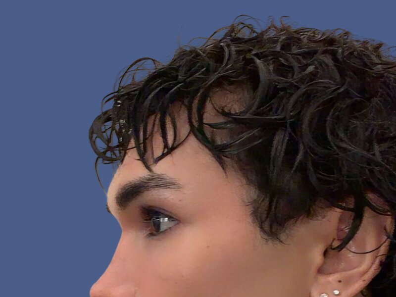 Brow Bossing Reduction Before & After Image