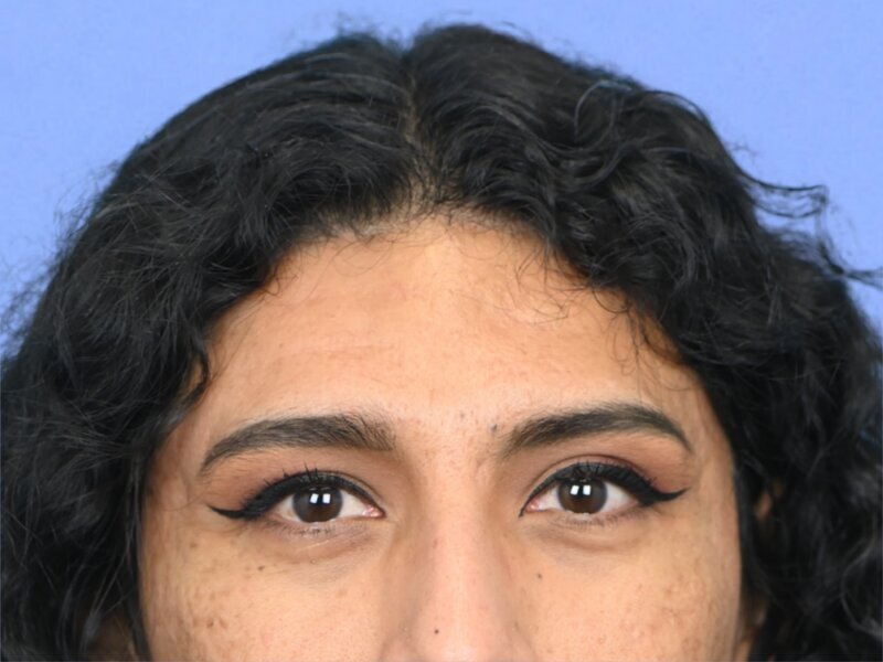 Brow Bossing Reduction Before & After Image