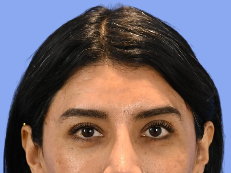 Brow Bossing Reduction Before & After Image
