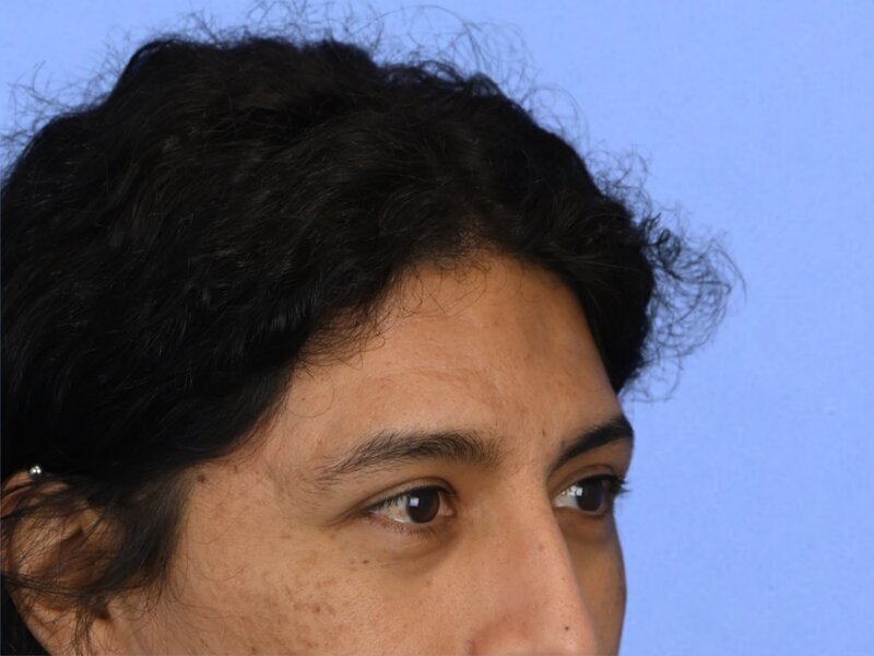 Brow Bossing Reduction Before & After Image