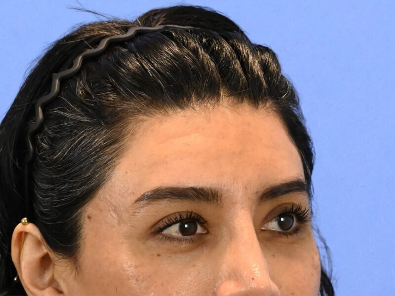 Brow Bossing Reduction Before & After Image
