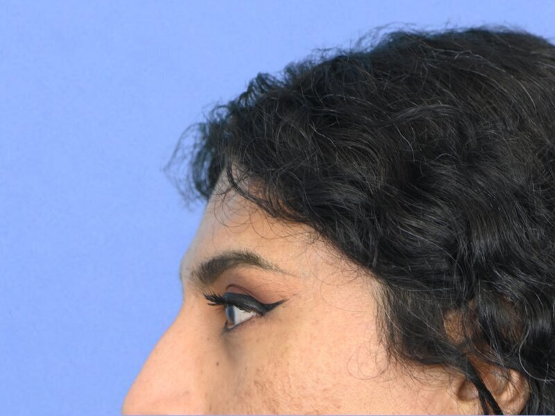 Brow Bossing Reduction Before & After Image