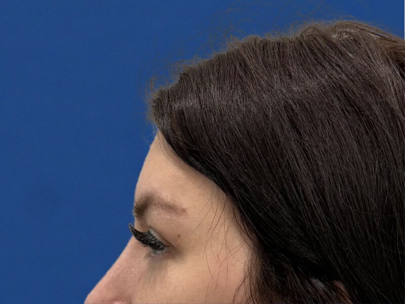 Brow Bossing Reduction Before & After Image