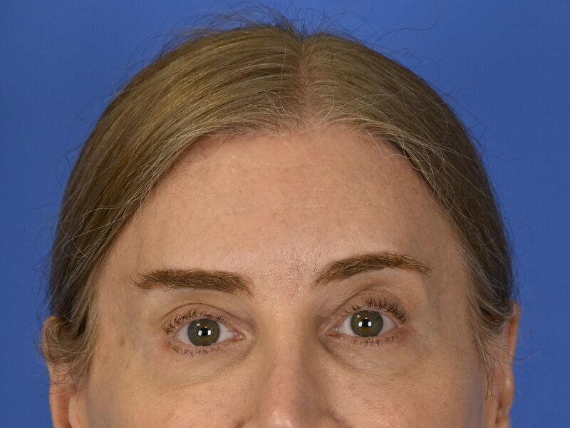 Brow Bossing Reduction Before & After Image