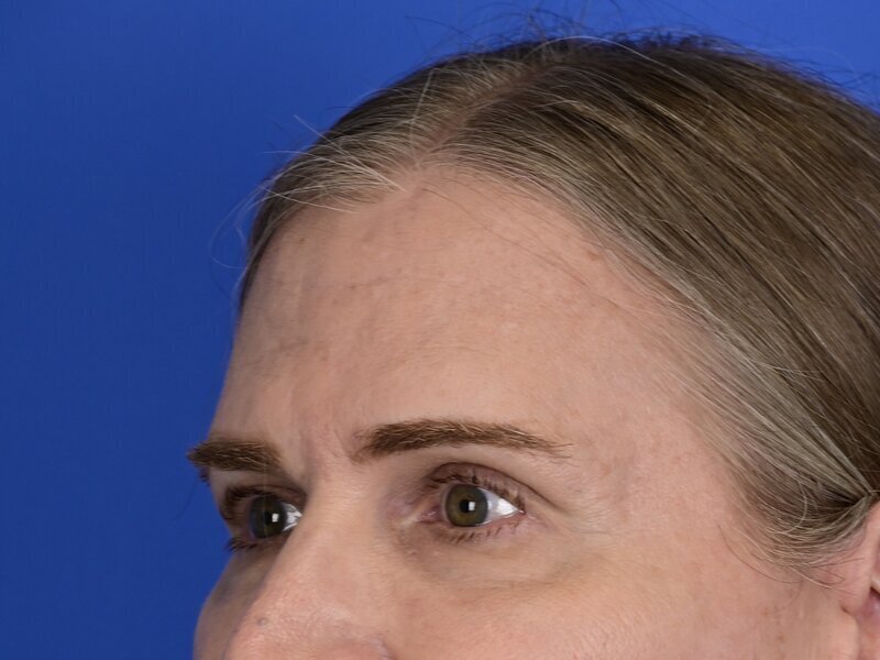 Brow Bossing Reduction Before & After Image