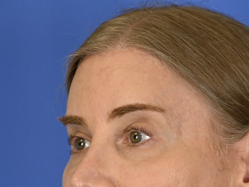 Brow Bossing Reduction Before & After Image