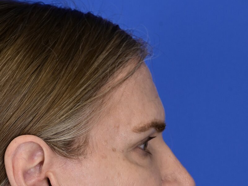 Brow Bossing Reduction Before & After Image
